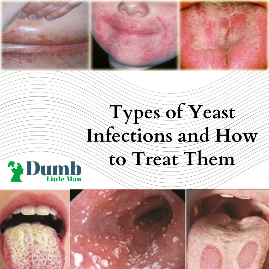 male-yeast-infection-home-remedies-for-yeast-infection-home